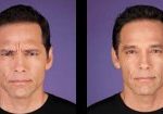 4-botox-before-after-kopelson-clinic-beverly-hills-220×105