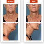 Kybella-Before-After-1