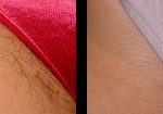 laser-hair-removal-beverly-hills-los-angeles-before-after-1-220×105