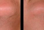 laser-hair-removal-beverly-hills-los-angeles-before-after-2-220×105