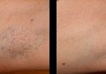 laser-hair-removal-beverly-hills-los-angeles-before-after-4-220×105