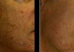 laser-resurfacing-beverly-hills-los-angeles-before-after-2-220×105
