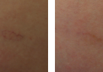 sclerorotherapy-before-after-2-220×105