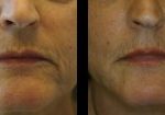 sculptra-beverly-hills-los-angeles-before-after-1.png-220×105